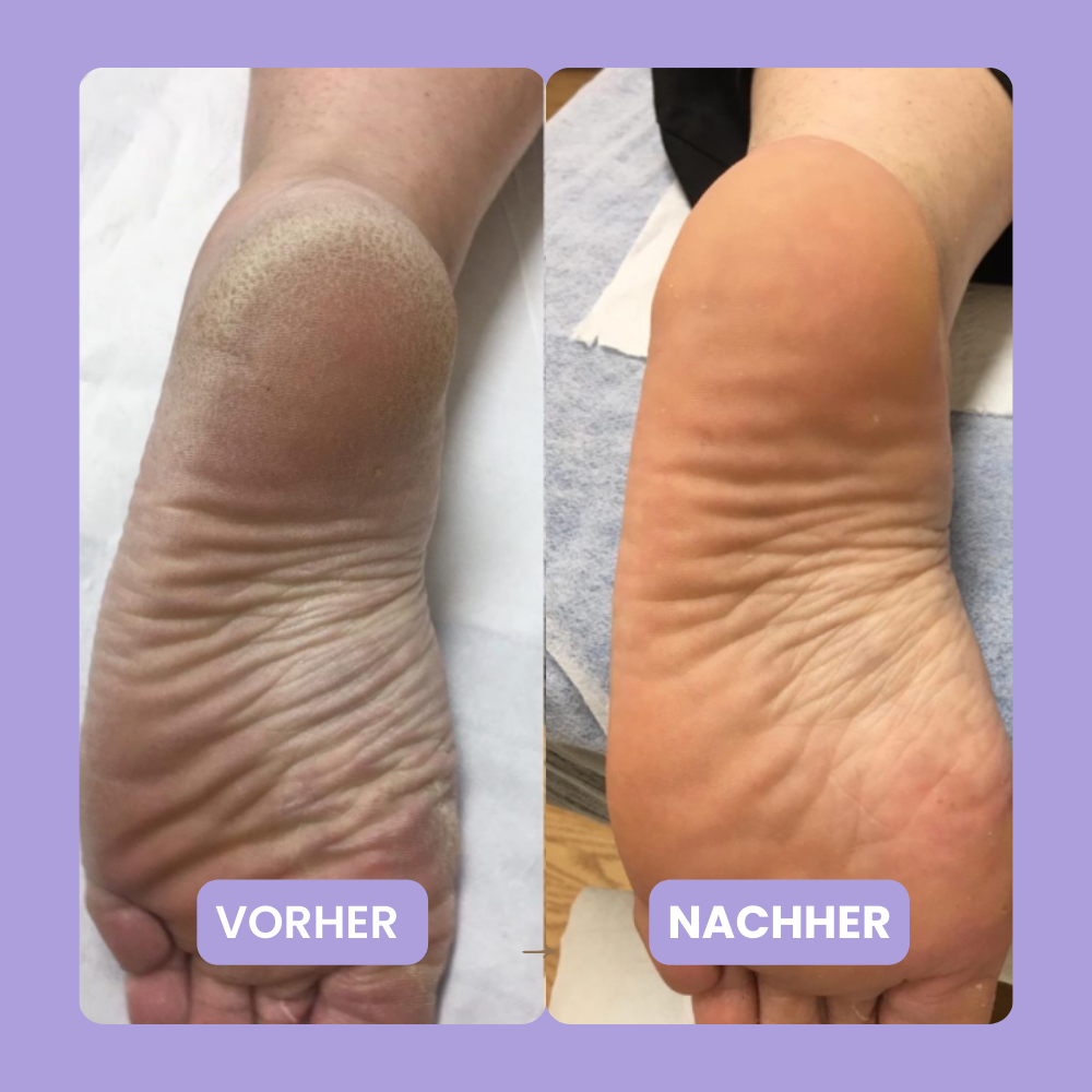 HornhautHero Plus – 2-in-1 Tool für Maniküre & Pediküre