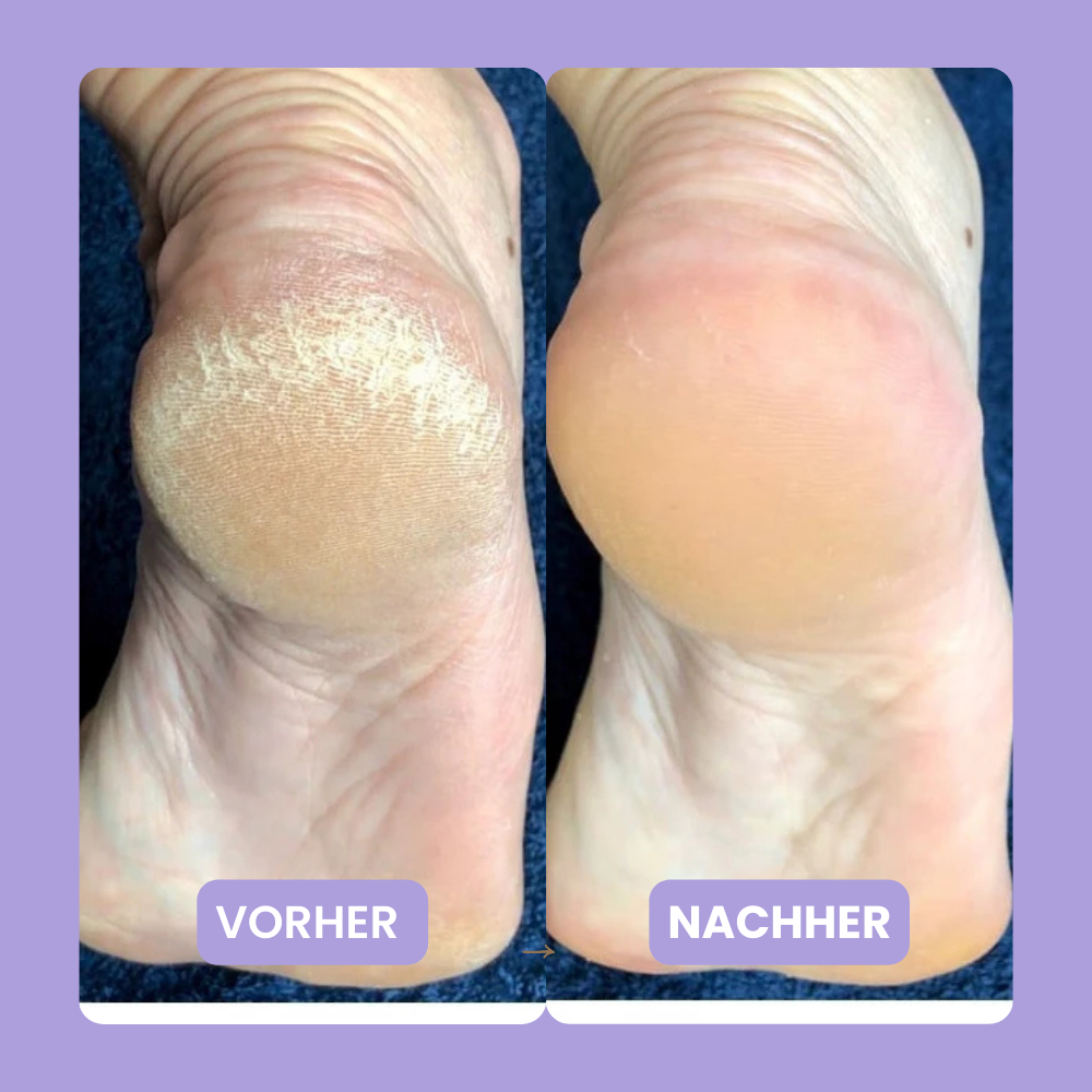 HornhautHero Plus – 2-in-1 Tool für Maniküre & Pediküre