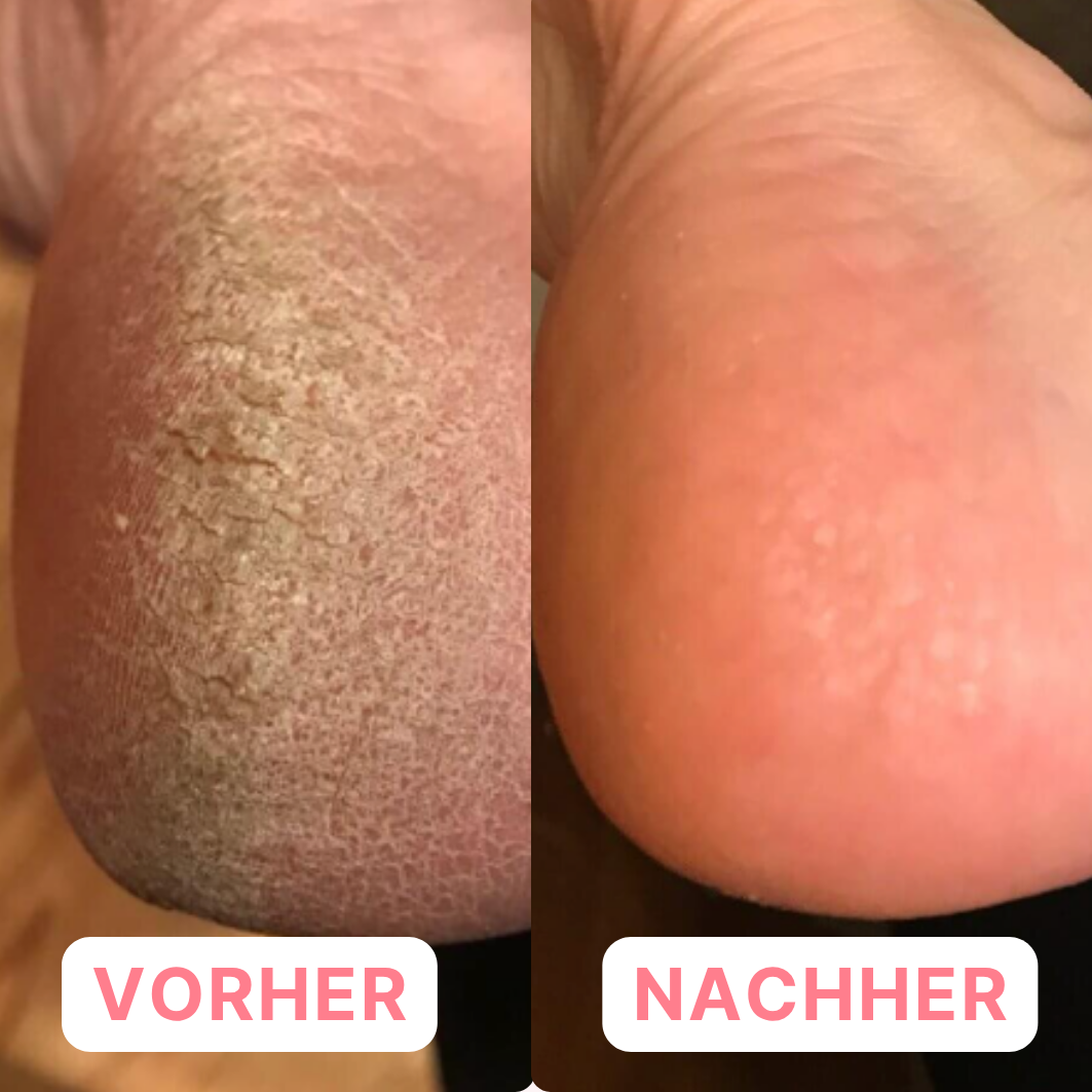 SilkSole™ – Fußmasken aus Silikongel