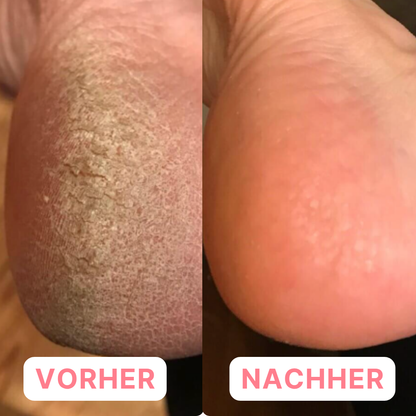 SilkSole™ – Fußmasken aus Silikongel