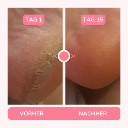 HornhautHero – Babyweiche Füße in nur 5 Minuten
