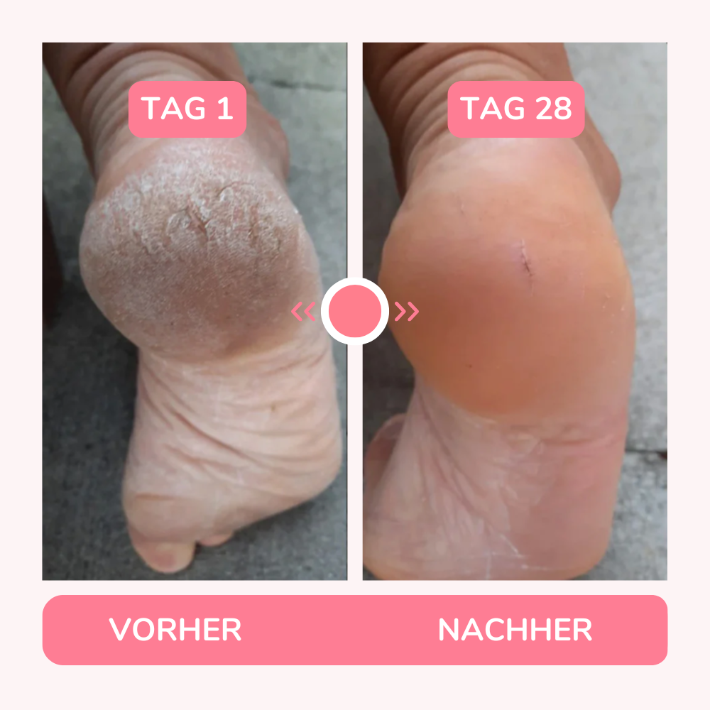 HornhautHero – Babyweiche Füße in nur 5 Minuten